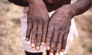 WHO cảnh báo virus đậu mùa khỉ có thể đã âm thầm lây lan