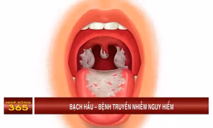 Bạch hầu – Bệnh truyền nhiễm nguy hiểm