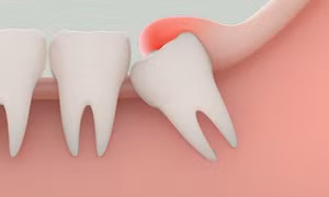 Chuyện cùng bác sĩ: Những điều cần biết về răng khôn