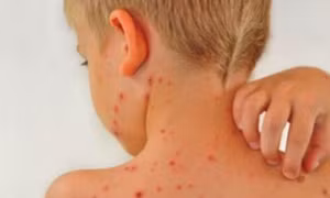 Bệnh chốc ở trẻ và những nhầm tưởng cha mẹ hay gặp