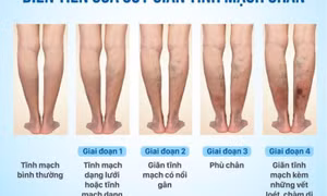 Suy giãn tĩnh mạch chân có chữa khỏi được không, ai có nguy cơ cao mắc bệnh?