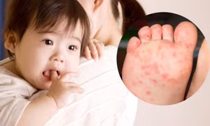 Trẻ bị tay chân miệng rồi có mắc lại không?