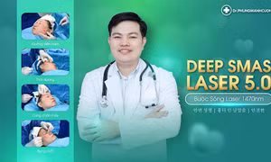 Căng da mặt Deep Smas Laser 5.0 - Phương pháp không phẫu thuật mới 