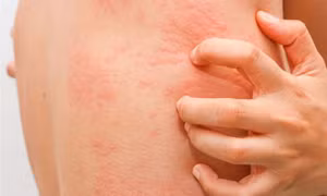 Ngứa nổi mẩn đỏ khắp người vào ban đêm mùa hè cảnh báo bệnh gì?