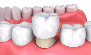 8 mối nguy từ việc bọc răng sứ không đảm bảo chất lượng