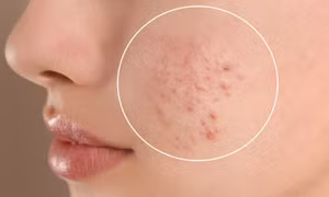 6 biểu hiện ở da cho thấy bạn đang thiếu vitamin