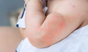 Viêm da ở trẻ trong mùa nắng nóng phòng tránh thế nào?