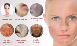 Nhận biết làn da bị "nhiễm độc" corticoid