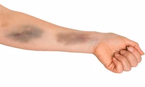 Hai màu sắc bất thường trên da cảnh báo bệnh gan nguy hiểm