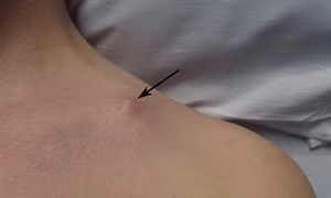 Chấn thương vai và vấn đề cần lưu ý