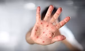 Hàn Quốc có ca bệnh đậu mùa khỉ đầu tiên lây truyền trong nước