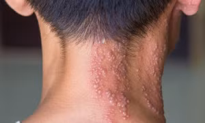 Cảnh báo, bệnh zona có thể gây viêm màng não