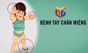 Cảnh giác với bệnh tay chân miệng