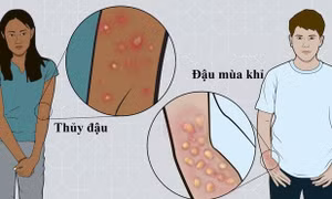 Phân biệt thủy đậu và đậu mùa khỉ