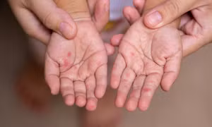Cách ban sởi lây lan trên cơ thể