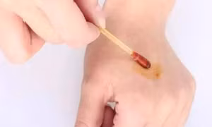 Cách chăm sóc những vết thương nhỏ đúng cách