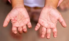 Biện pháp '3 sạch' giúp phòng bệnh tay chân miệng