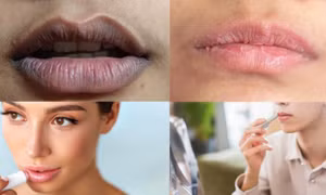Mách bạn mẹo giúp giảm thâm môi
