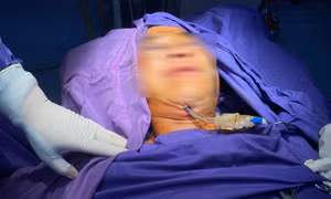 Kỹ thuật mới điều trị đa chấn thương vùng hàm mặt