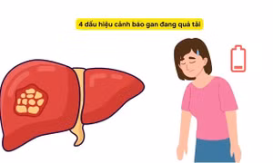 4 dấu hiệu cảnh báo gan đang quá tải