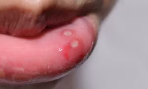 Nguyên nhân và cách khắc phục nhiệt miệng