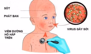 Biện pháp phòng ngừa bệnh sởi cho trẻ