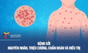 Nguyên nhân, triệu chứng, chẩn đoán và điều trị bệnh sởi