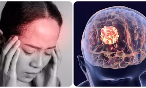 Ung thư não có những triệu chứng gì?