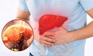 Men gan tăng đột biến sau thời gian nghe "bác sĩ mạng" bày uống trà thải độc