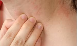 Ngứa kéo dài có thể là dấu hiệu cảnh báo sớm suy thận