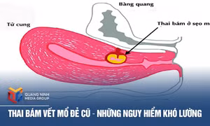 Thai bám vết mổ đẻ cũ – Những nguy hiểm khó lường
