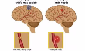 Trời lạnh dễ gây đột quỵ