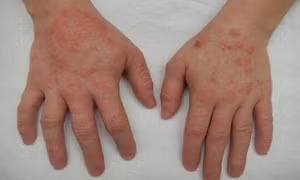 Vì sao viêm da cơ địa dễ tái phát vào mùa lạnh?