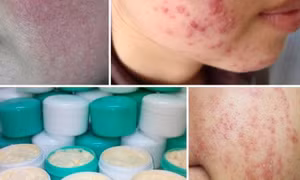 Dùng thuốc đông y, kem trộn chứa corticoid - Tiềm ẩn nhiều hệ lụy nguy hiểm