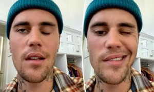 Justin Bieber bị liệt nửa mặt do hội chứng hiếm gặp