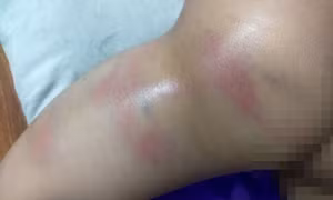 Xác minh vụ việc bé gái 4 tuổi nghi bị cô giáo đánh bầm tím