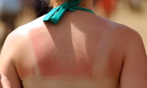 Bị cháy nắng mùa hè, tuyệt đối không nên làm 9 điều này
