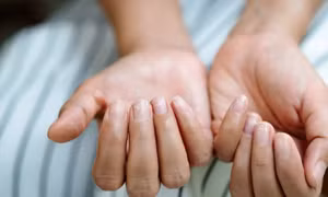 COVID-19: Triệu chứng đáng chú ý ở móng tay và chân