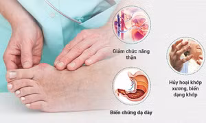 7 cách “chung sống hòa bình” với bệnh gout