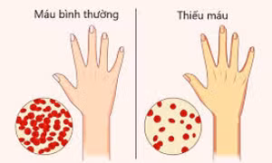 Những dấu hiệu sớm cảnh báo thiếu máu