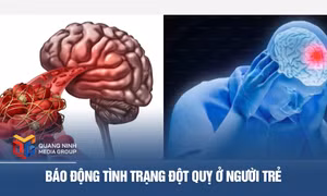Báo động tình trạng đột quỵ ở người trẻ