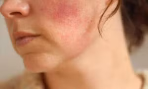 Biến chứng "chết người" khi lạm dụng, tự ý dùng Corticoid