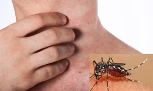 Việt Nam sẽ tiêm thử nghiệm vaccine sốt xuất huyết của Nhật Bản