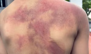 Bé trai 5 tuổi chi chít vết thương khắp người do cha ruột đánh