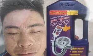 Dùng nước thông cống siêu tốc, nhiều người bỏng phải nhập viện cấp cứu