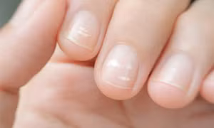 Dấu hiệu nhỏ trên móng tay cảnh báo nhiều nguy cơ tiềm ẩn