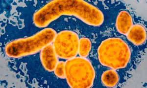 Virus bí ẩn gây viêm gan lan ra 11 nước, ca đầu tiên tử vong