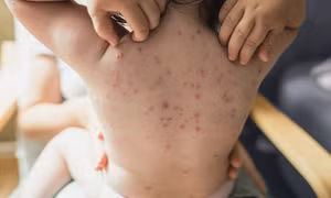 Bệnh thủy đậu vào mùa và những lưu ý khi dùng thuốc