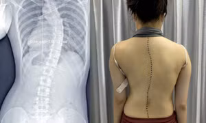 Vẹo cột sống ở trẻ gây hệ lụy gì?