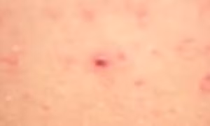 Ba người tử vong do virus Hanta, Bộ Y tế khuyến cáo 5 biện pháp phòng bệnh